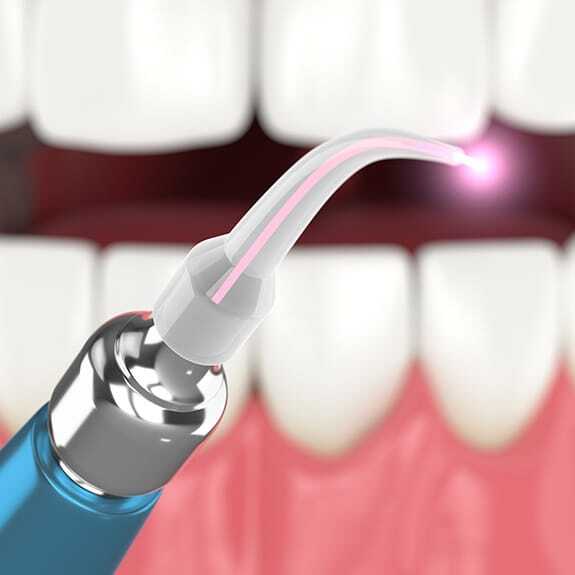 laser-dentistry-1 (1)